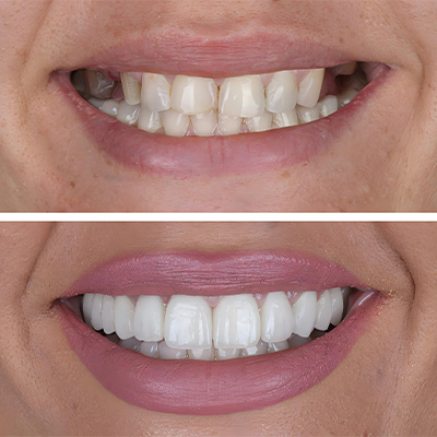 Porcelain Veneers