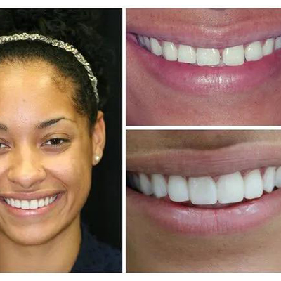 Porcelain Veneers