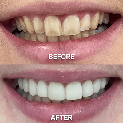 Porcelain Veneers