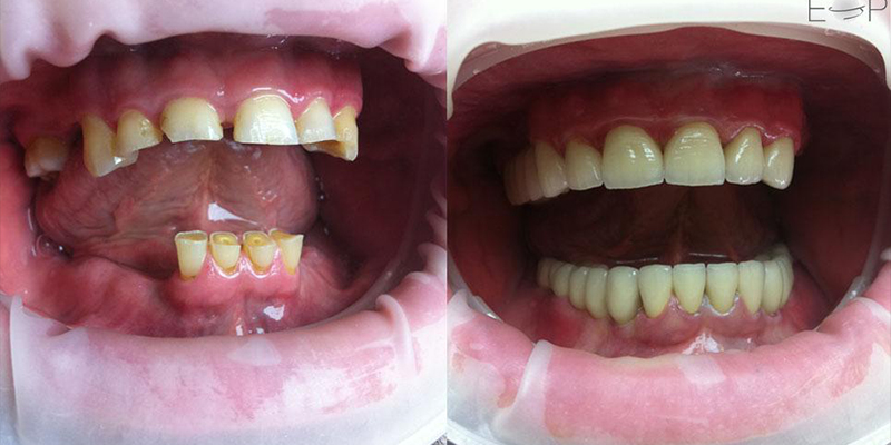 Implant Bridge
