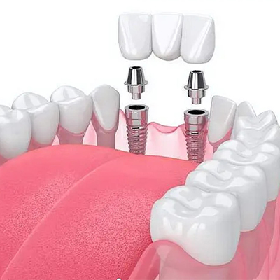 Multiple Implants
