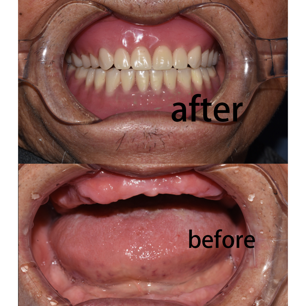 Full Mouth Rehabilitation