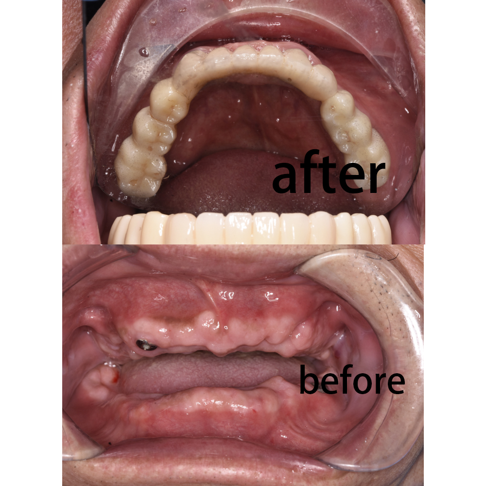 Dental Implants