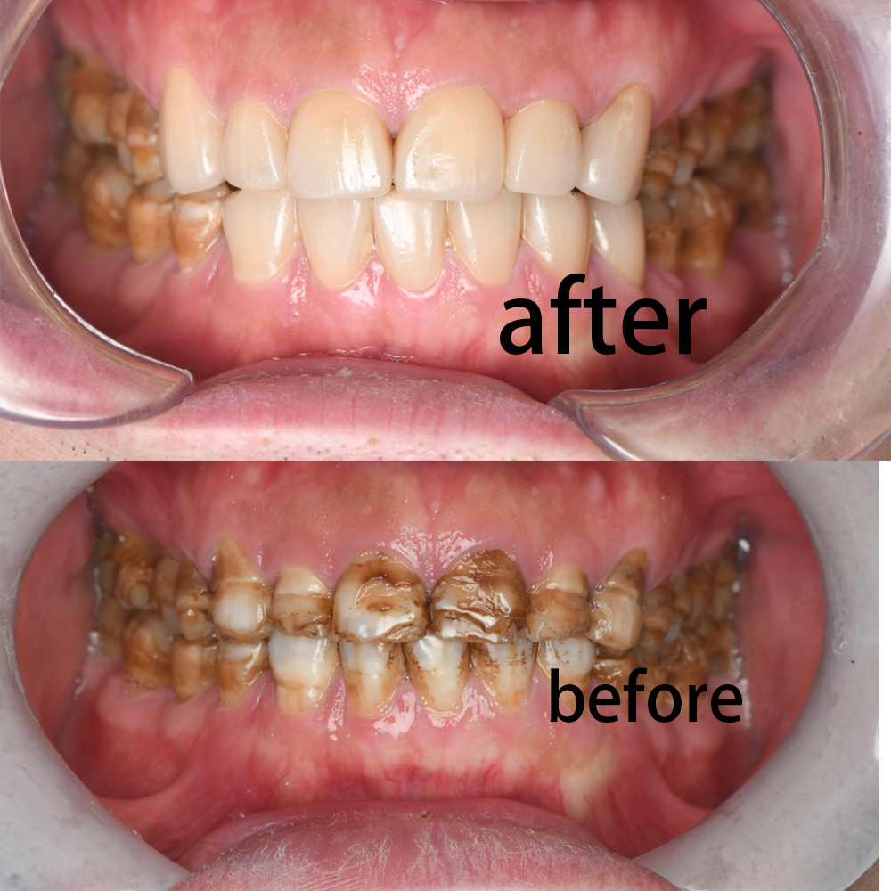 Veneers